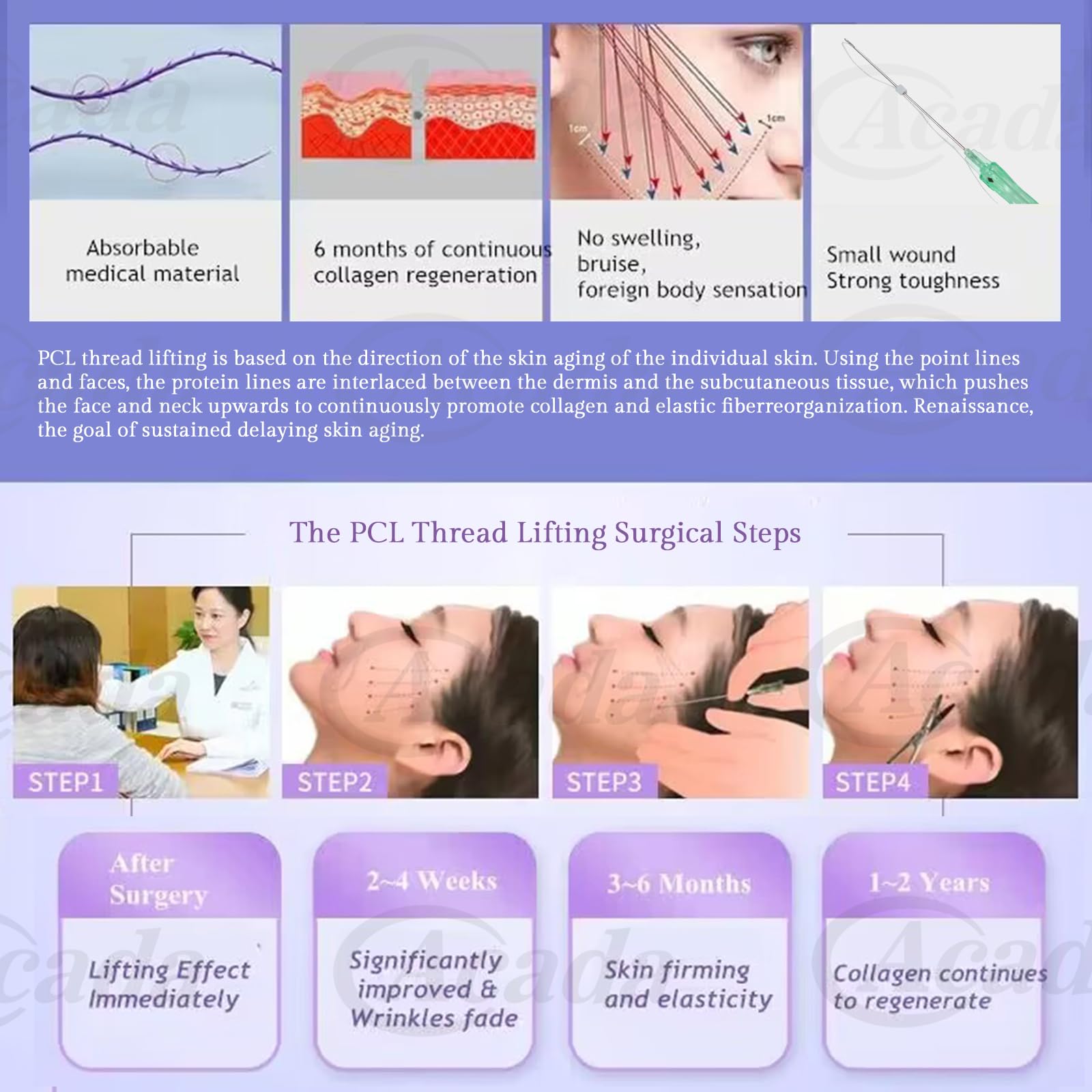 PCL Cog Threads for Face Lift , Fox Eye Lift Brow Lift  Blunt Type 21G60mm - 20Pcs