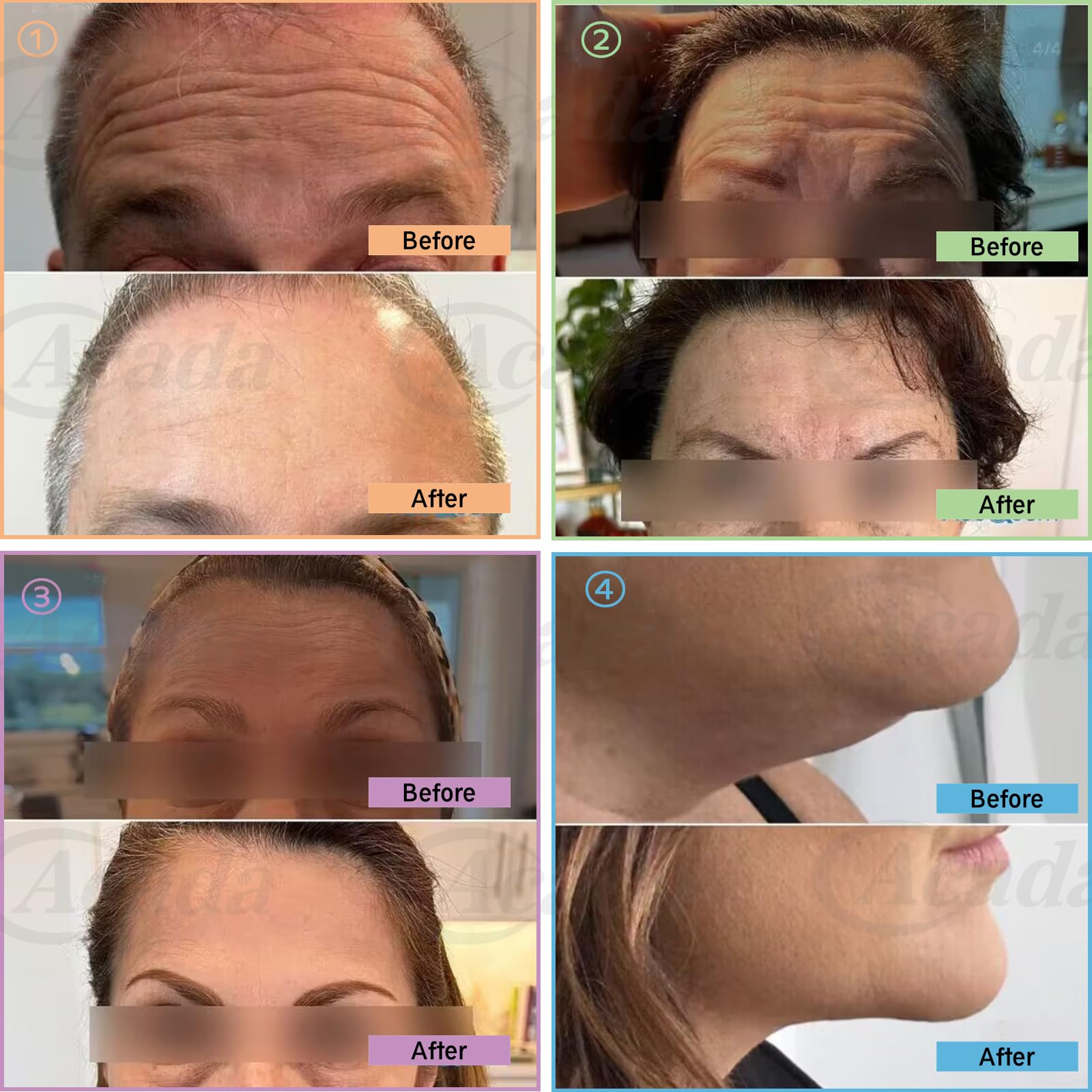 PCL Multi Threads for Face Lift, Filling of Sunken Areas, Wrinkle Care 23G38mm Blunt L-Type - 20Pcs