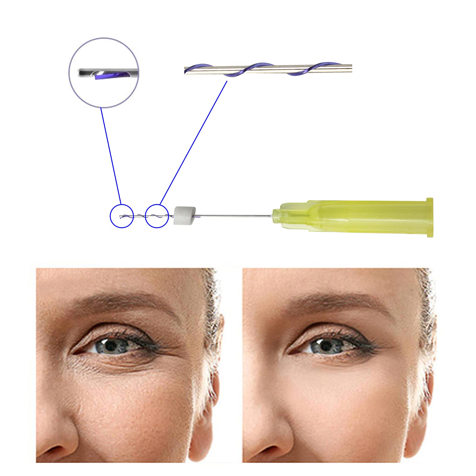 PDO Thread Lift Mono Screw Eye Thread W Blunt for Eye Area 20pcs