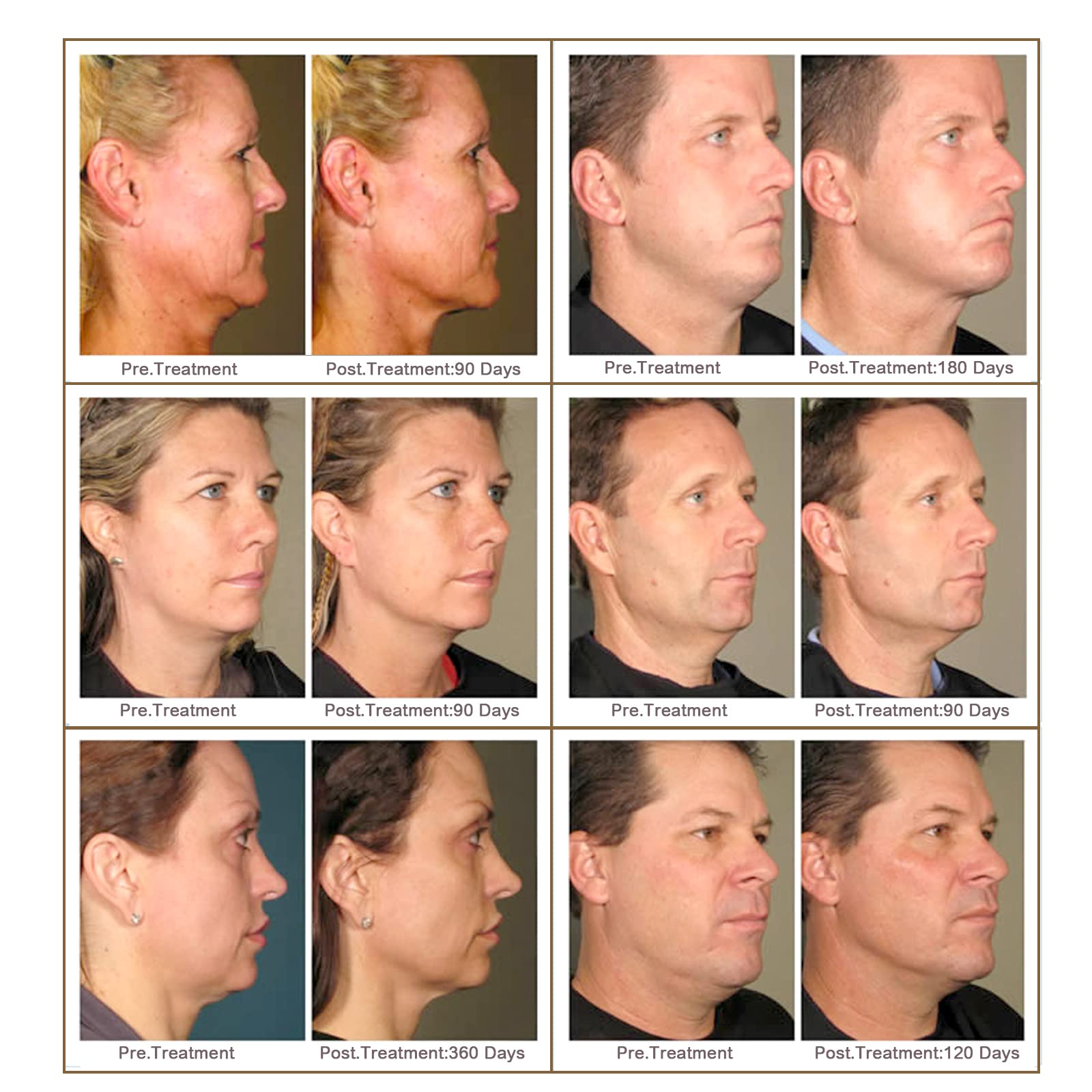 PCL Threads Lift Mono Screw Type 30G-25mm 20pcs for Face/Whole Body